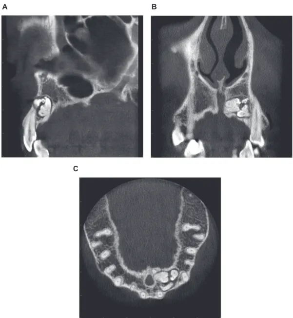 Figure 4  Representative example of a cone beam computed tomography (CBCT) scan exhibiting an odontoma type of supernumerary tooth in the anterior  maxilla (A: sagittal CBCT image; B: coronal CBCT image; C: axial CBCT image).