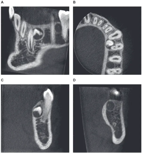 Figure 5  Representative example of a cone beam computed tomography (CBCT) scan exhibiting two supernumerary teeth classified as developing tooth  buds in the left posterior mandible (between canine and first premolar, and second premolar and first molar; 