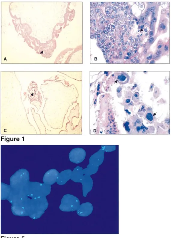 Figure 5. This shows an example of 46,XX complete hydatidiform mole. Two X-chromosomes speci®c signals after FISH on placental tissue are seen