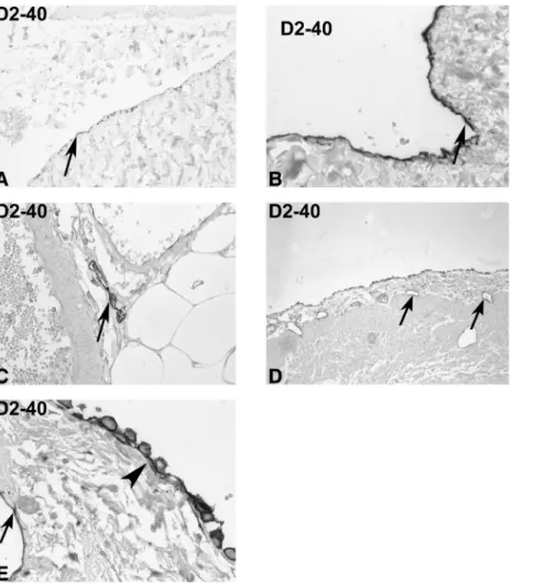 Fig. 1. Expression of podoplanin in controls. Immunohistochemistry was performed on tissue sections from peritoneal biopsies taken at the time of hernia repair (A – C) or during appendectomy (D, E) with the monoclonal antibody D2-40 against podoplanin (ori