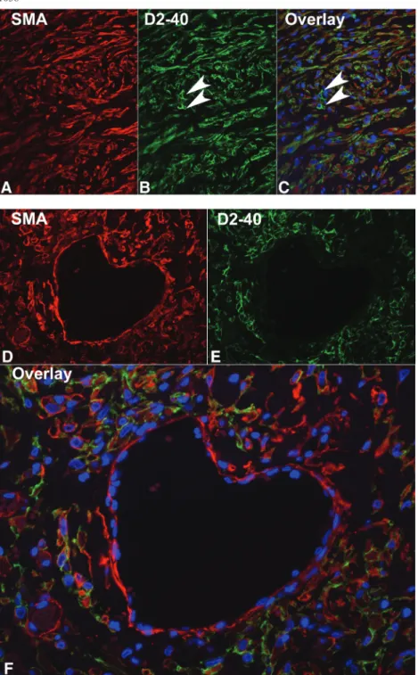 Fig. 4. Double immunofluorescence for podoplanin and smooth muscle actin in EPS. Double immunofluorescence was performed on biopsies with EPS for smooth muscle actin (A, D) and podoplanin (with the monoclonal antibody D2-40, (B, E), orig