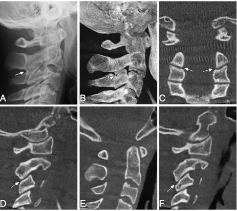 Figure  1  Conventional  lateral  cephalogram  (A)  and  cone  beam  computed  tomography  (CBCT)  images (B-F) of the same patient: (A) lateral cephalogram with an absence of a continuous radiolucent  area between the cervical vertebrae C2 and C3 (possibl