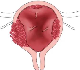 Figure 2 Scheme of deep placental invasion (placenta acreta, increta, percreta).