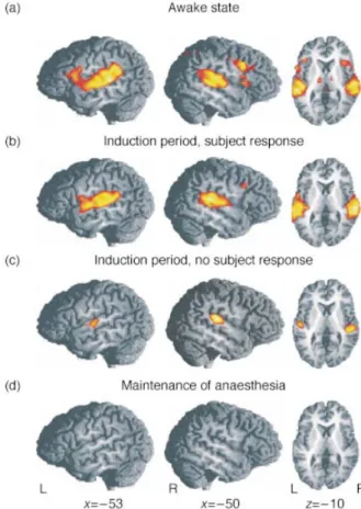 Fig 2 Functional activation induced by the auditory language processing task (compared to rest) averaged over all 12 subjects (z thresholded at z=3.09 corresponding to P<0.001 mapped onto a reference brain