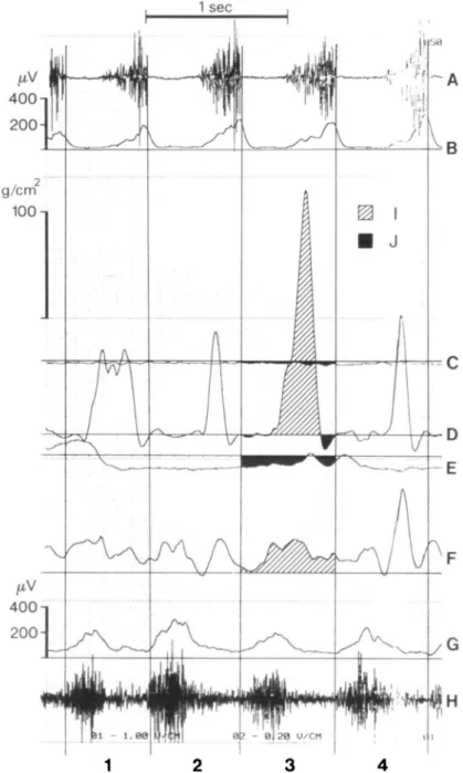 Figure 2 Electromyographic and pressure recording of chewing. (A) Direct recording of anterior temporal muscle activity.