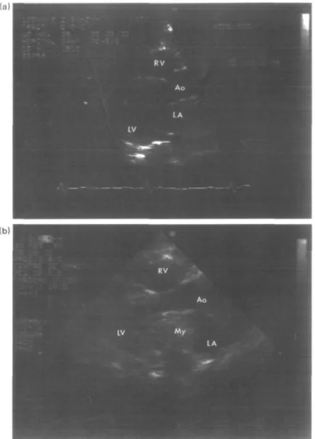 Figure 1 (a) Transthoracic echocardiogram in the left pastemal view LA = left atrium;