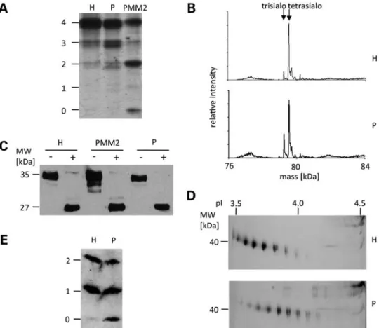 Figure 1. Glycosylation of serum glycoproteins. (A) IEF of transferrin from healthy control (H), patient (P) and PMM2 deficient patient (PMM2)