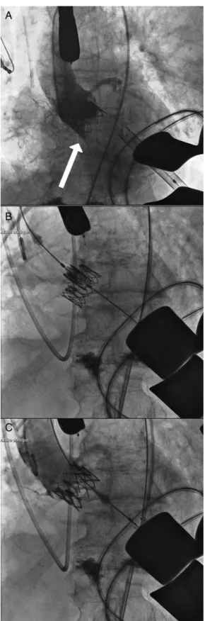 Figure 1: Intraoperative ﬂ uoroscopic images: (A) at the time of the ﬁ rst transa- transa-pical TAVI, the paravalvular leak grade 1 (arrow) is the result of a repeated  valvu-loplasty with an additional 1 ml of contrast in the balloon; (B) the repeated urg