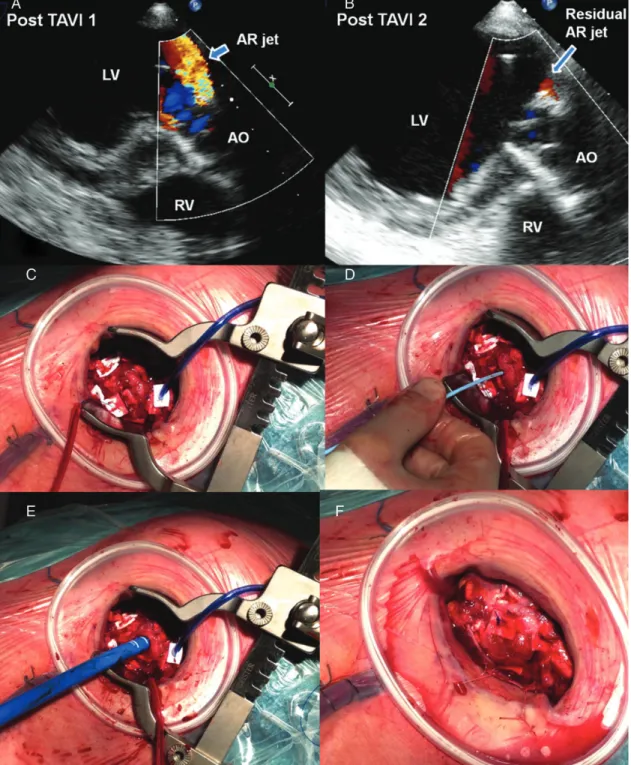 Figure 2: (A and B) Echocardiographic views of the paravalvular leak after the ﬁrst TA-TAVI (A) and after the redo TA-TAVI (B) (intragastric LVOT views: 130°