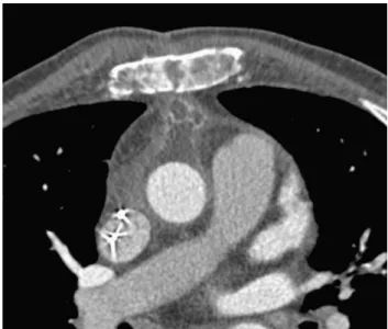 Fig. 1. Contrast enhanced CT-scan following second look surgery displays a retrosternal mass which patterns are consistent with an abscess: high attenuation rim, which circumscribes a low attenuation multilocated collection.