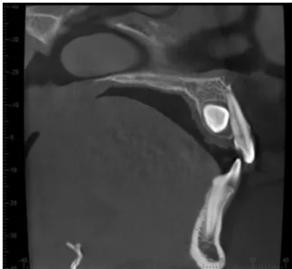 Figure 1  Representative example of a sagittal CBCT scan exhibiting a  palatally located impacted canine.