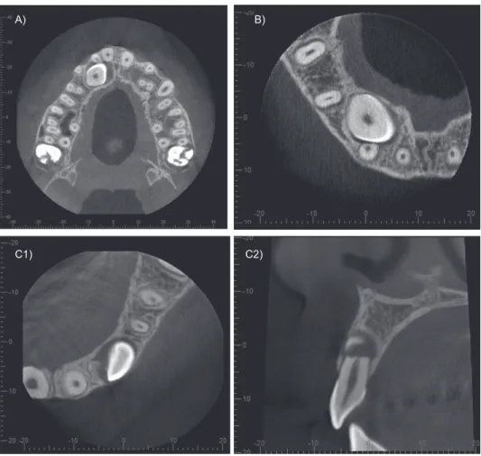 Figure 5  Representative example of an impacted canine crossing the maxillary midline (A: volume rendered image and B: axial CBCT scan).