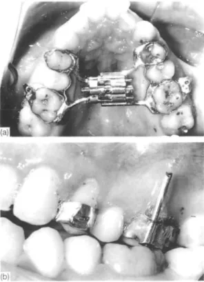 Figure I (a) Patient J.M.: occlusal view of the Hyrax mio