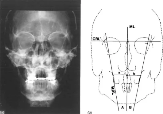 Figure 4 (a) Postero-anterior (P.A.) head-film from patient J.M. (T,). (b) Reference points, lines and angles measured on the P.A