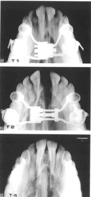Figure 7 Overall expansion and relapse measured between the upper canines and between the first molars on the casts.