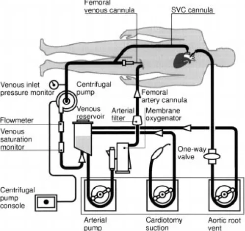 Fig. 1. CPB circuit diagram representing the perfusion layout.