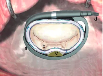 Figure 1: The Mitralﬂex without the Dacron coating showing its three com- com-ponents: a: the external rigid ring; b: the internal deformable ring to be sutured to the mitral annulus; c: the sliding element that reshape the inner ring according to the pati