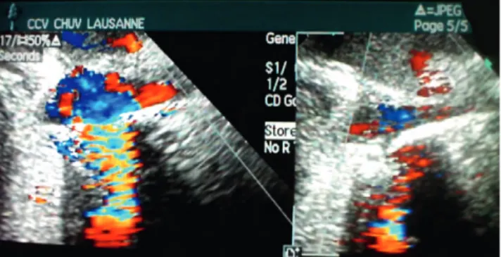 Figure 3: The Mitral ﬂ ex ring is implanted using the interrupted suture technique.