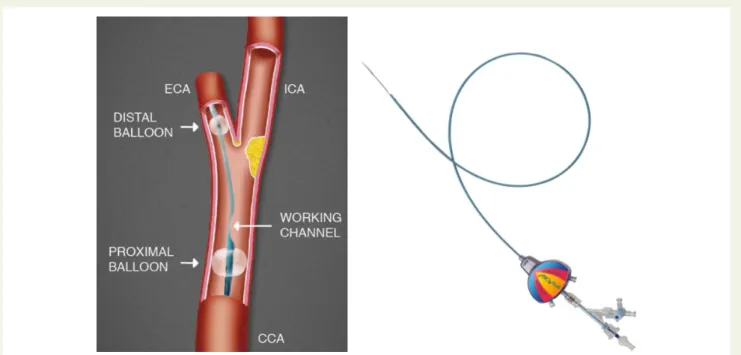 Figure 1 Mo.Ma TM working concept and device. The distal and the proximal balloons occlude the external carotid artery and the common carotid artery (left panel)