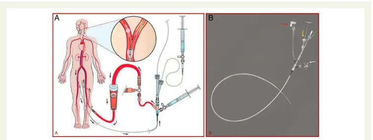 Figure 2 NeuroProtection System TM working concept (A) and device (B) with its multiple ports (arrows).