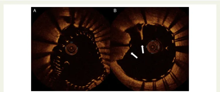 Figure 4 Optical coherence tomography findings inside an open-cell carotid stent. (A) Malapposition of the stent to the vessel while (B) intra-strut plaque prolapse (arrows).