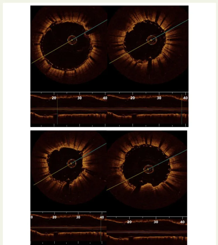 Figure 6 Optimal coherence tomography assessment of a RoadSaver TM stent showing no significant prolapse of plaque and good wall apposition.