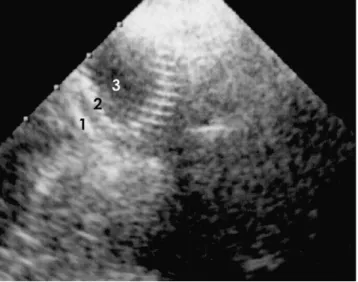 Fig. 4. Expanded smart canula W visualized in the vena cava close to the right atrium with TEE (with permission from 7): wall of the vena cava (1), metallic structure of the opened self-expanding cannula (2), and its lumen (3)