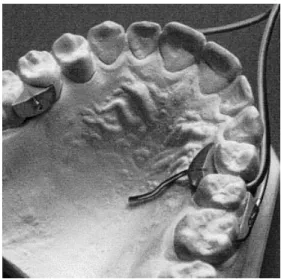 Figure 2 Mouthpieces for the measurement of the pressures in the maxilla.