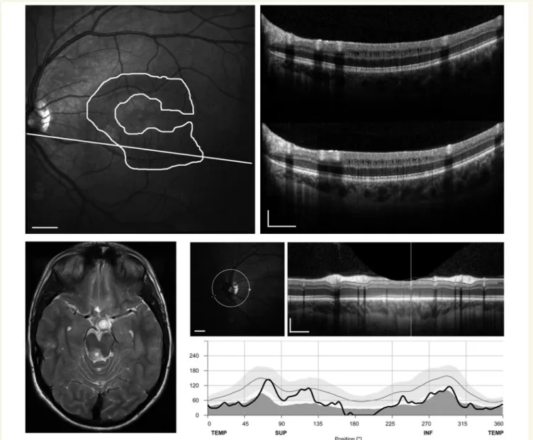 Figure 1 Bilateral microcystic macular degeneration in a 13-year-old male with neurofibromatosis type 1 and optic atrophy from a chiasmal glioma