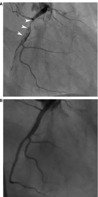 Figure 1. (A) Coronary angiography revealing thrombotic occlusion of proximal and mid segments of the right  cor-onary artery with collateral flow from the left anterior  des-cending artery