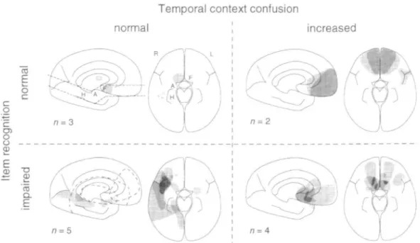 Fig. 3 Lesion reconstruction showing the projection of lesions to the midsagittal plane and a combined axial plane encompassing the hippocampus (H), the amygdala (A), and the orbitofrontal area (including basal forebrain, F) as indicated in the upper left 