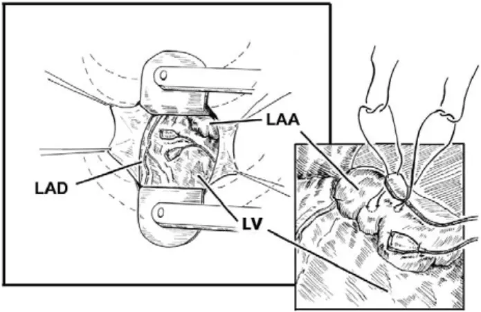 Fig. 1. Illustration depicting the left lateral thoracotomy incision, and position of the electrodes on the left heart structures, with pacemaker battery in place.