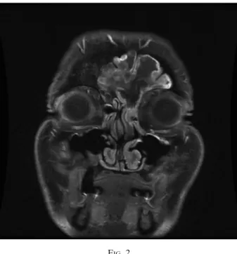 Table I shows reports of isolated frontal sinus fungus ball published in the last 25 years.