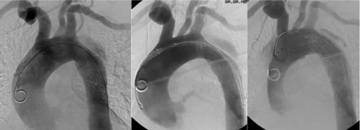 Figure 1: Retrograde aortic type A dissection during placement of a stent graft in a acute complicated type B dissection.