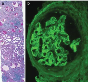 Fig. 3. Third graft biopsy performed 7 years after transplantation: (A) overview of the biopsy with severe scarring, glomerular obsolescence and collapse, and one hypertrophic glomerulus surrounded by hypertrophic tubules (PAS, × 40); (B) collapsed glomeru