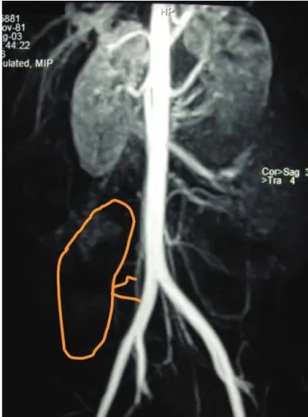 Fig. 5. Second native kidney biopsy performed 2 years after graft nephrec- nephrec-tomy: (A) two hypertrophic glomeruli with thickened basement  mem-branes and slightly increased mesangial matrix