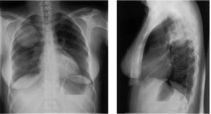 Figure 1. Posteranterior (left) and lateral (right) chest radiographs obtained at presentation show a well-defined round mass in the right upper lobe