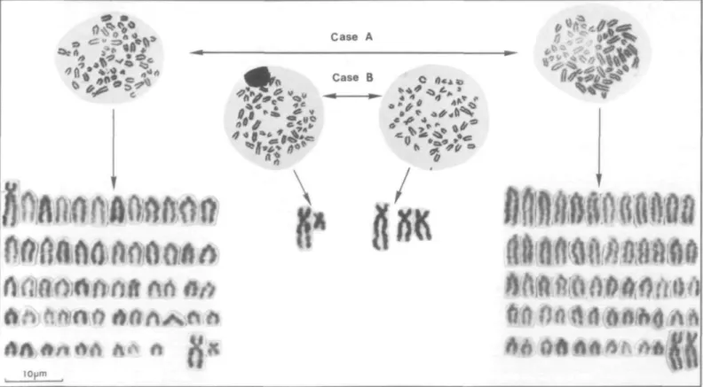 FIGURE 2 Metaphases (case A and B) and two karyotypes (case A) and additional significant chromosomes (case B) of the chimeric cattle twins.