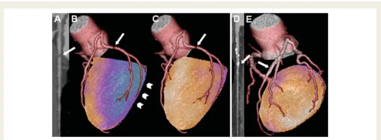 Figure 1 Visualization of matched and unmatched cardiac hybrid images. Cardiac hybrid single-photon emission computed tomography/cor- tomography/cor-onary computed tomography angiography images of a 40-year-old patient show a stenosis [(A), arrow] and a ma