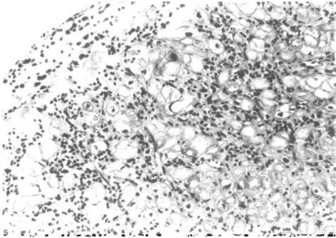 Figure 5 Confluent lymphocytic infiltrate of myocardium and endocardium accompanied by obvious vacuolization of myocytes and beginning fibrosis
