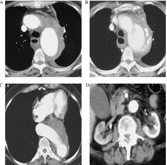 Fig. 1. Periaortic hematoma with left-sided hemothorax (A); dissection and aortic rupture at the distal arch level (B); huge kinking of the distal thoracic aorta (C); and disease-free infrarenal aorta (D).