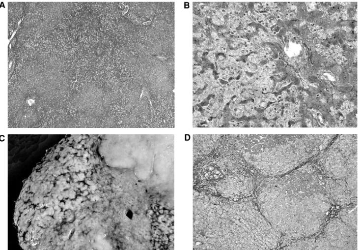 Figure 1. (A) Low-power examination on trichrome Masson stain of the liver revealed areas of sinusoidal congestion involving centrilobular and 