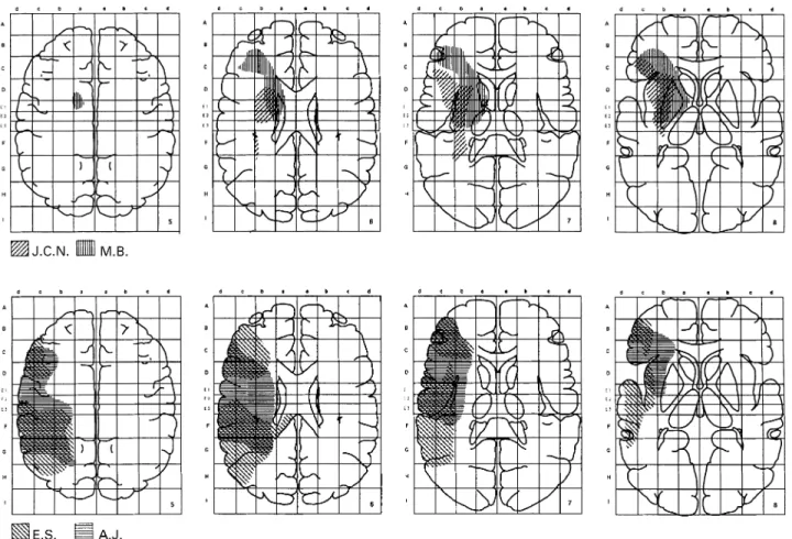 Fig. 5 Cerebral lesions of J.C.N. and M.B. (top row), and E.S. and A.J. (bottom row). M.B