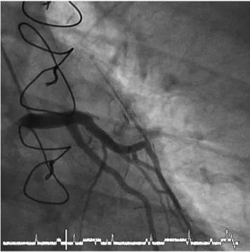Fig. 1. Left main coronary artery with the LAD and the CX arteries originating from the huge aneurysm.