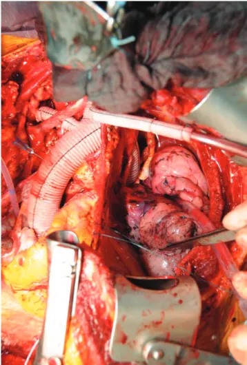 Figure 1: Overview of surgical access and completed total thoracic aortic repair.