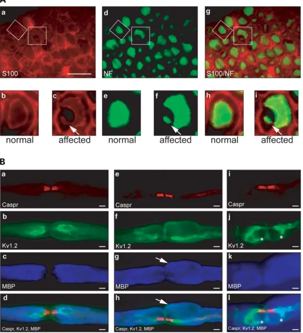 Figure 7. Immunohistochemical analysis of Mtmr2 m/m sciatic nerves. (A) Colocalization study on sciatic nerves of 9-month-old Mtmr2 m/m mice using S100 as a Schwann cell marker (a – c) and NF-L as an axonal marker (d – f)