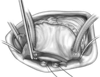 Figure 1: Right pulmonary vein ablation performed by temperature-controlled bipolar radiofrequency device after positioning of a pair of temporary wires on the right pulmonary veins.