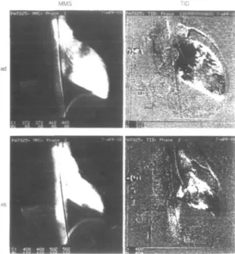 Figure 2 Representative digital angiogram in the right anterior oblique (RAO) projection in a patient with normal left ventricular function