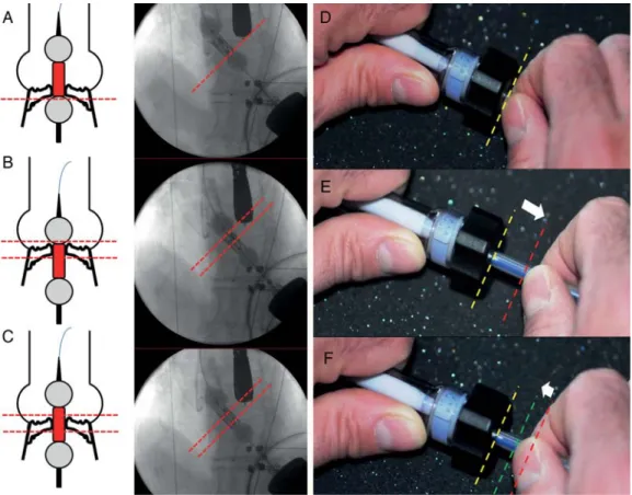 Figure 2: (A–C) Schemes (left) and ﬂuoroscopic images (right) of the modiﬁed ‘dumbbell’ technique during a transapical TAVR: (A) the partially inﬂated balloon catheter carrying the crimped stent valve is gently pushed towards the stenosed aortic valve: whe