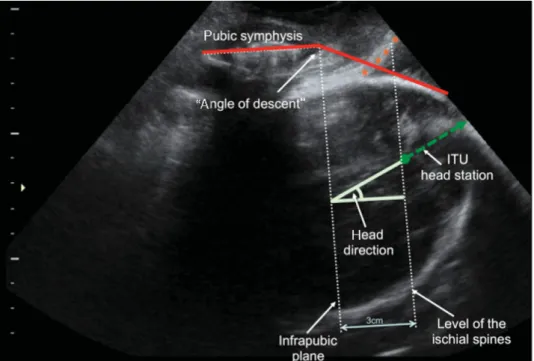 Figure 1 Possible objective parameters of ITU. All quantitative parameters require an exact median section of the pubic symphysis
